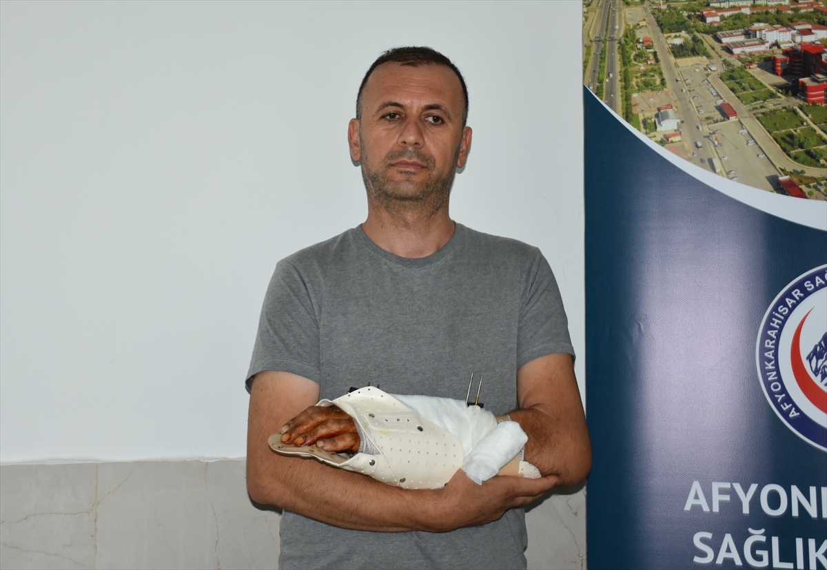 Bilekten kopmak üzere olan eli, 12 saatlik operasyonla kurtarıldı