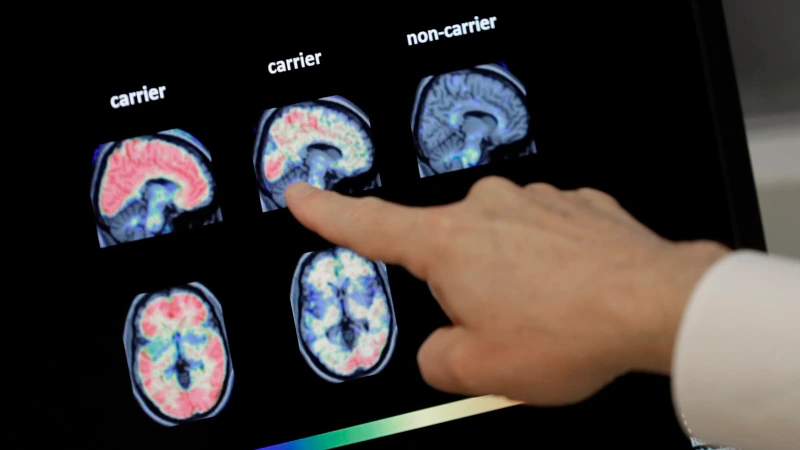 ABD’den Alzheimer İlacına Tarihi Onay