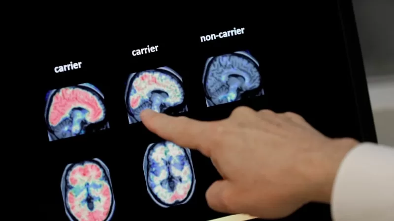 Umut veren Alzheimer ilaçları beyazlarda daha etkili